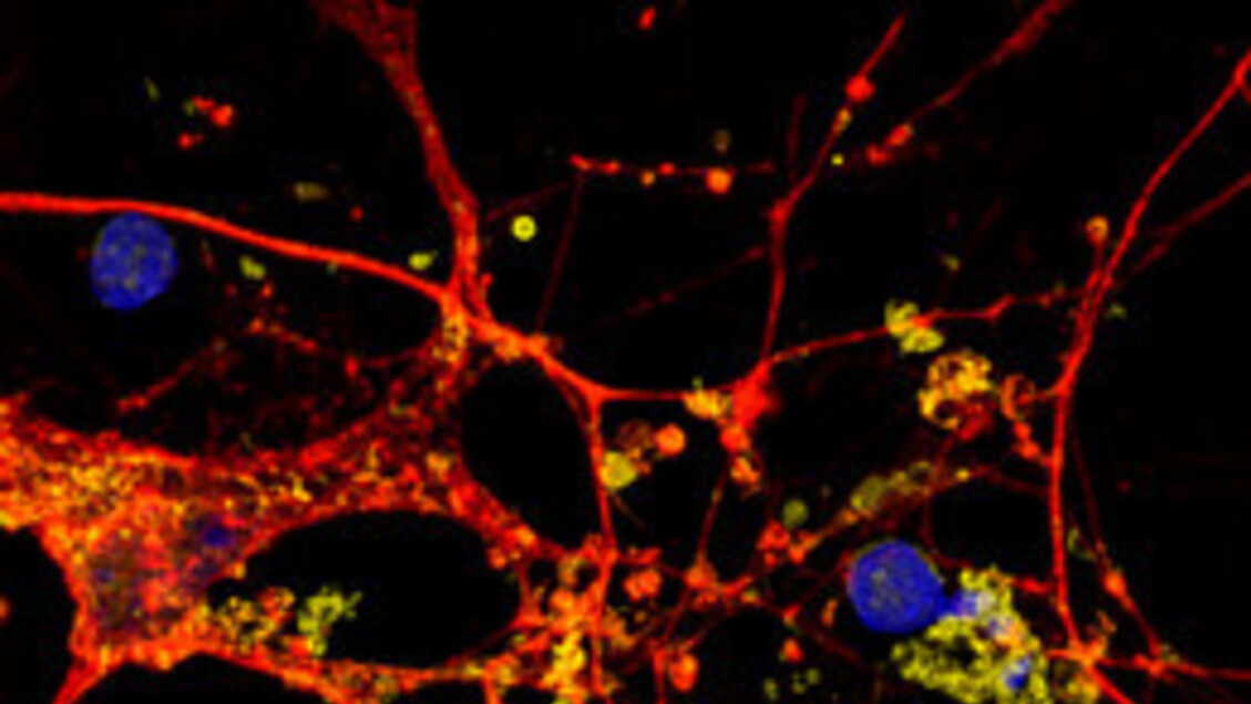 Un farmaco per il colesterolo potrebbe rivelarsi efficace contro la demenza