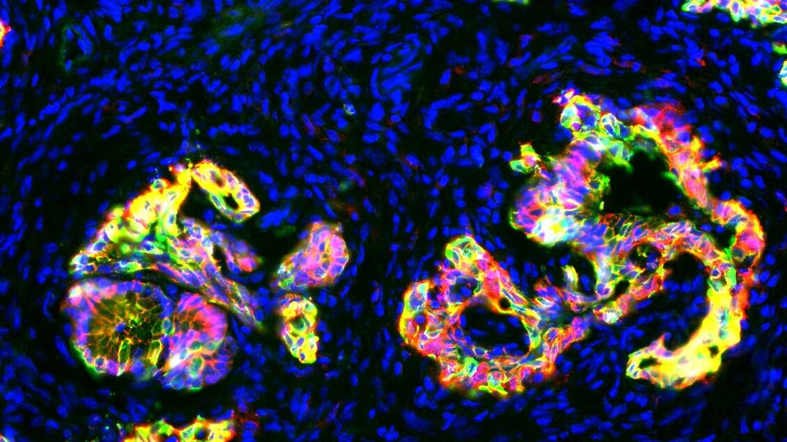 Dalla luce emerge la tecnica per differenziare cellule tumorali e sane