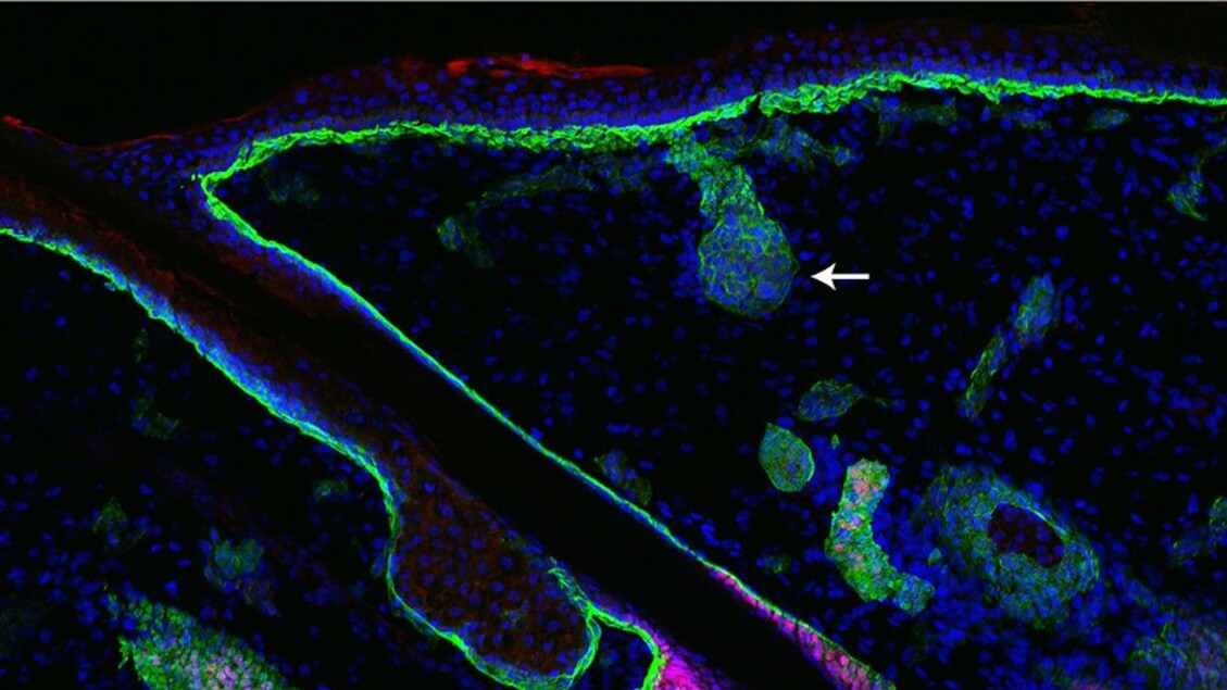I capelli bianchi: un meccanismo di difesa contro il cancro spiegato dagli esperti